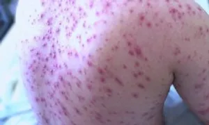 Thủy đậu dễ lây nhiễm ra sao? Thủy đậu dễ lây nhiễm ra sao?